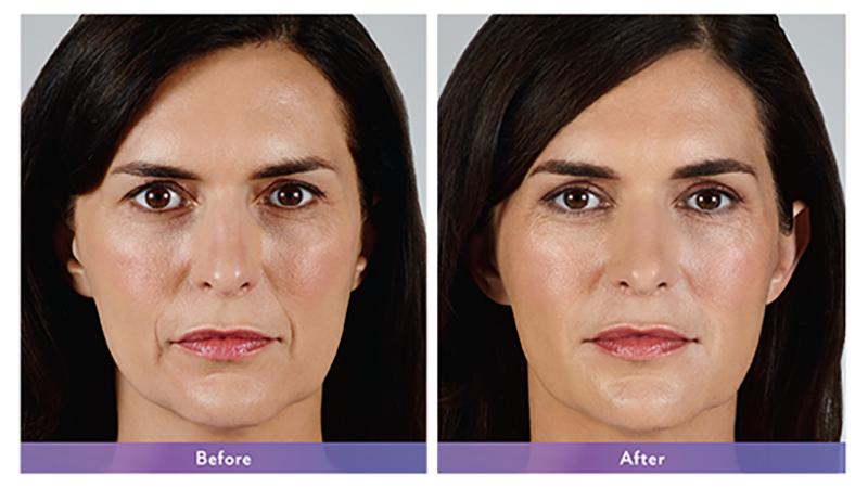 Juvederm