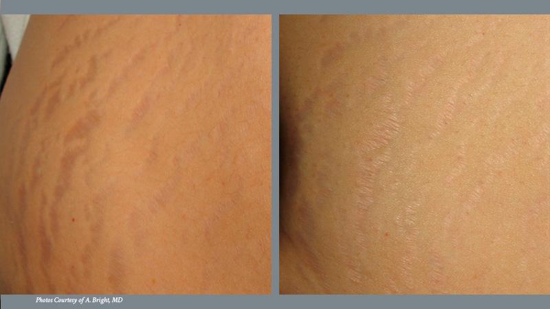 Stretch Mark Before and After